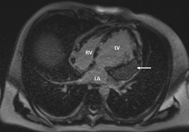 Four-chamber axial-phase sensitive inversion recovery sequence view. Cardiac magnetic resonance imaging revealed a 7.7 × 6.2 × 6.2 cm heterogeneous intra-myocardial mass (arrow) involving trans-mural left ventricle adjacent to the stented segment of the left anterior descending (LAD) artery. Similar lesions were present in other parts of left ventricle as well as right atrium (RA) at superior vena cava–RA junction. There was no focus of fungal lesion in the lungs. The right ventricle (RV) is also shown.